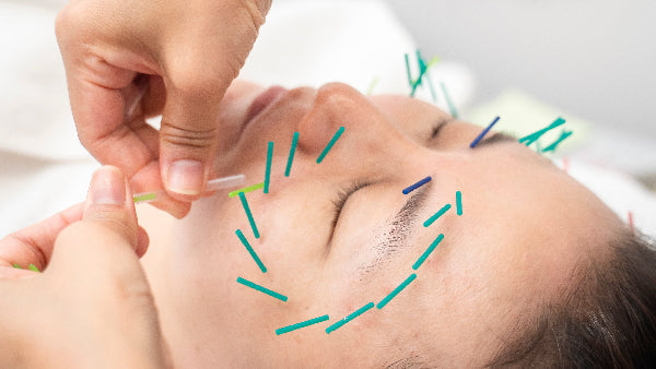How Long Do Acufacial Results Last? What to Expect After Treatment