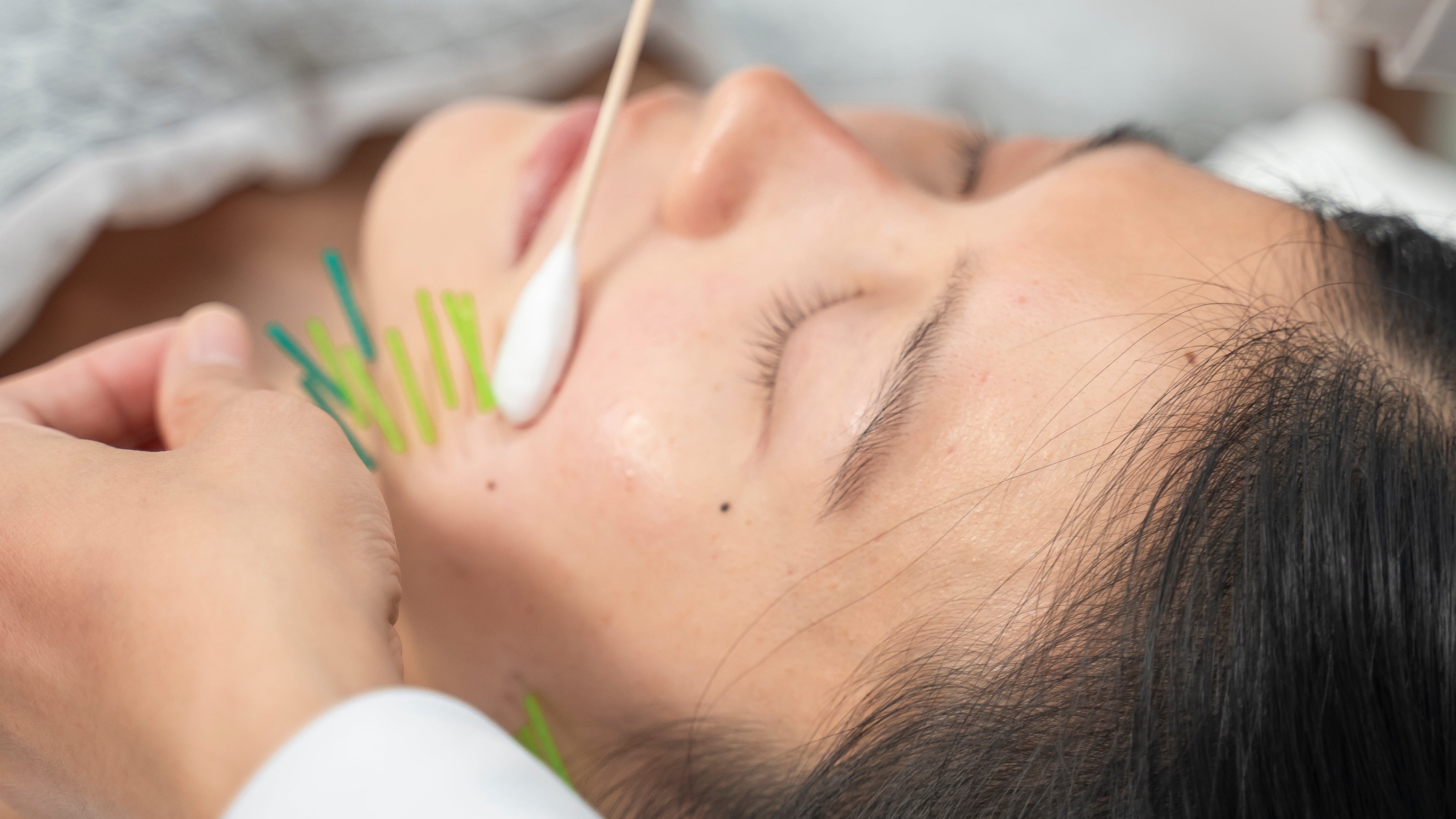 Does Acufacial Leave Marks or Scars? What to Expect After Treatment