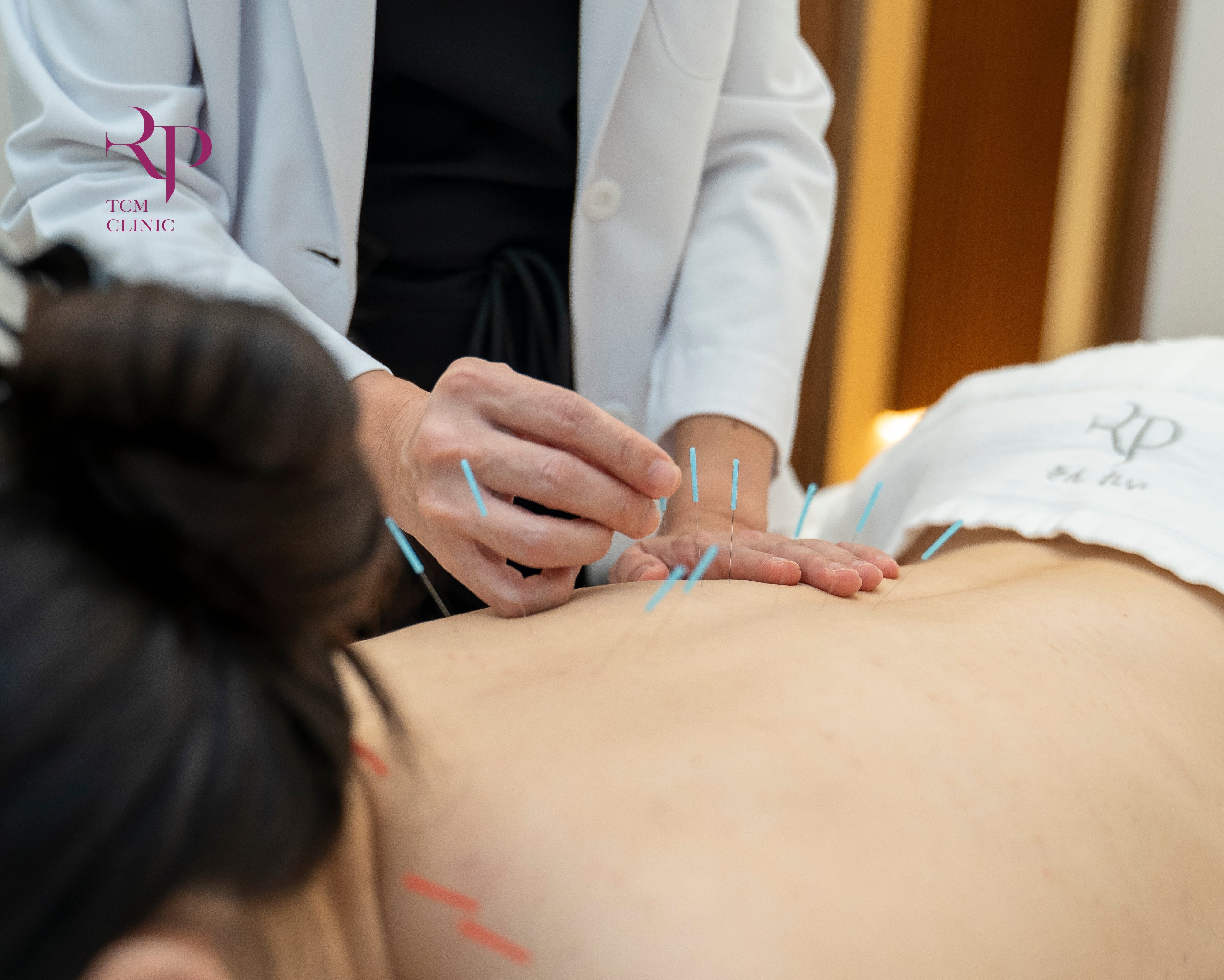 Person receiving acupuncture treatment with a healthcare professional.
