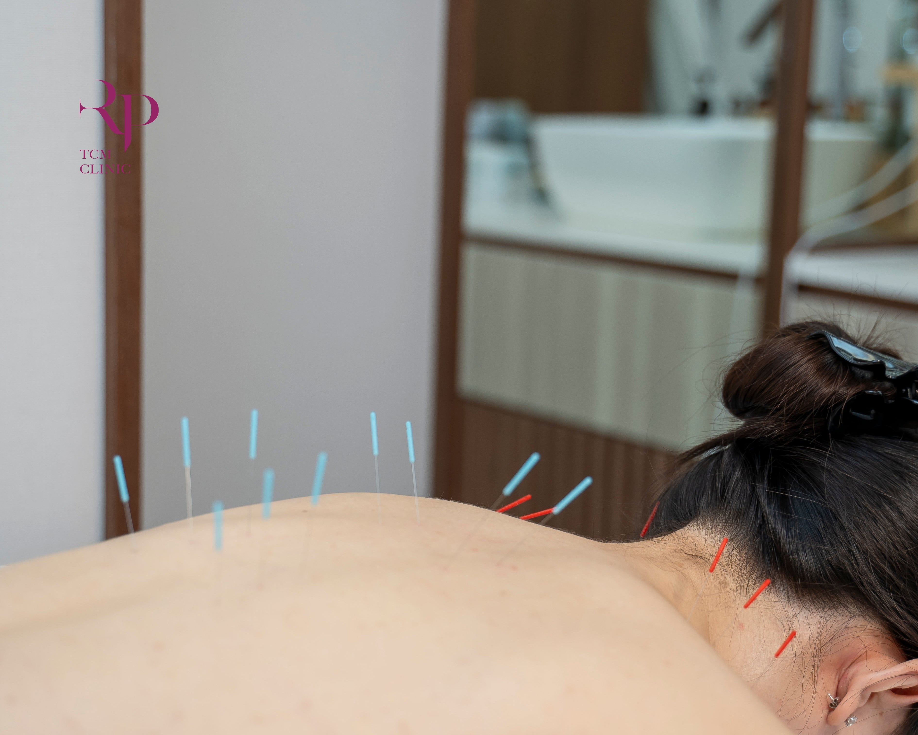 Person receiving acupuncture with needles on their back in a clinical setting.
