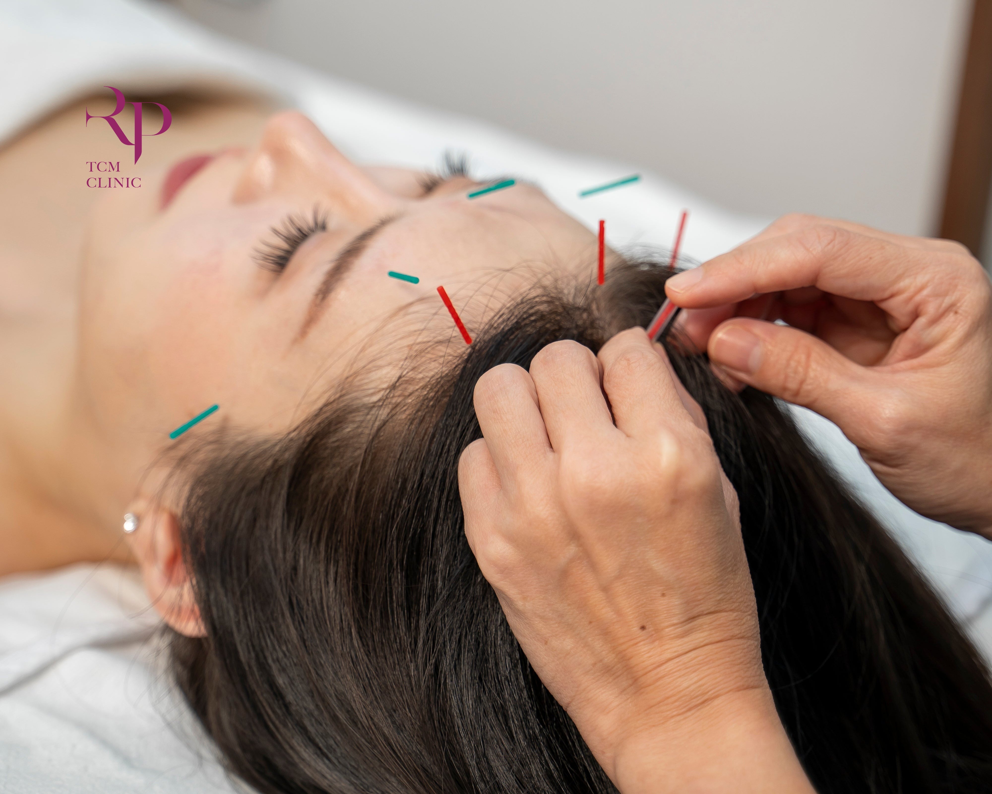 Person receiving acupuncture on the head with needles inserted.