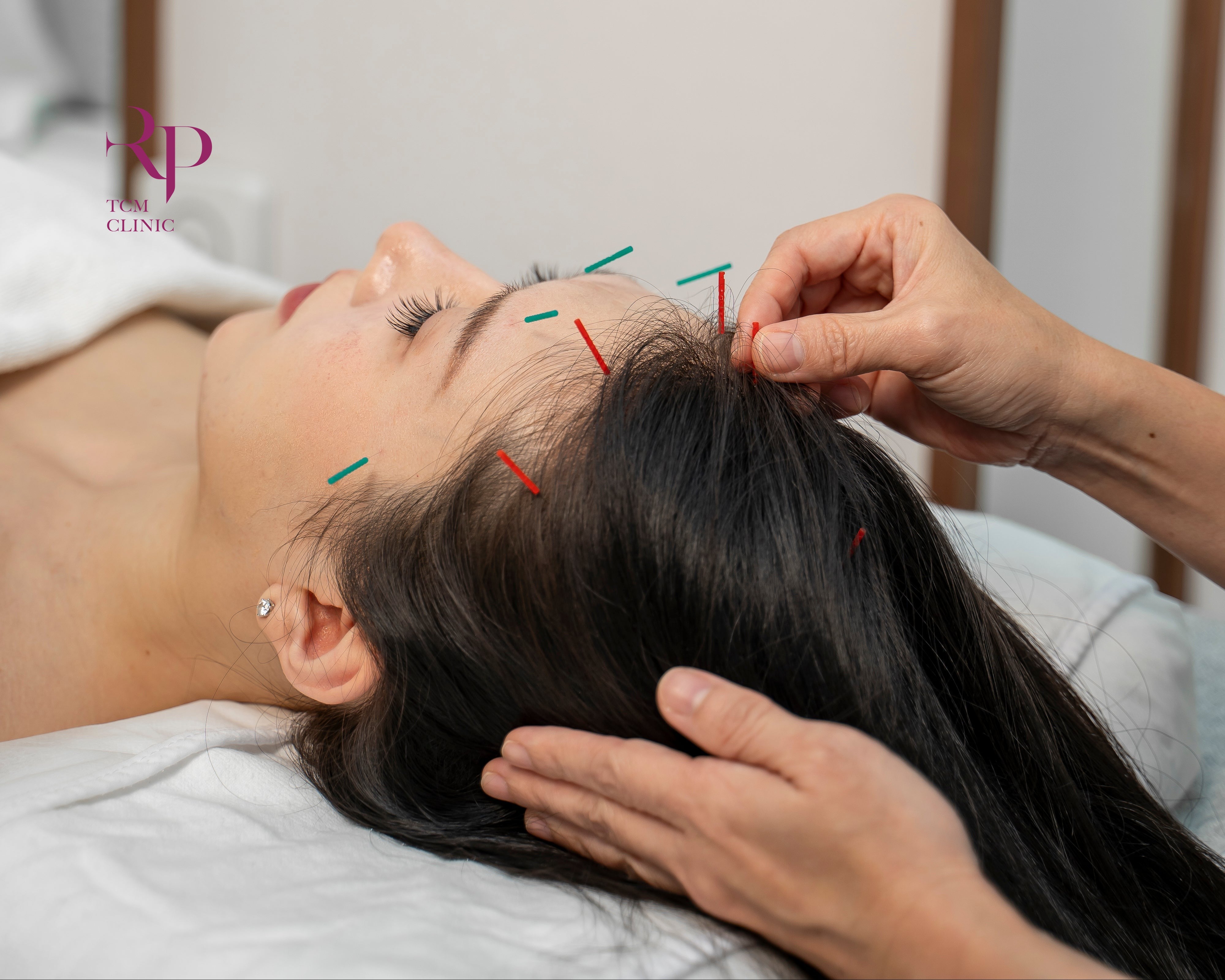 Person receiving acupuncture therapy on the head with needles inserted.