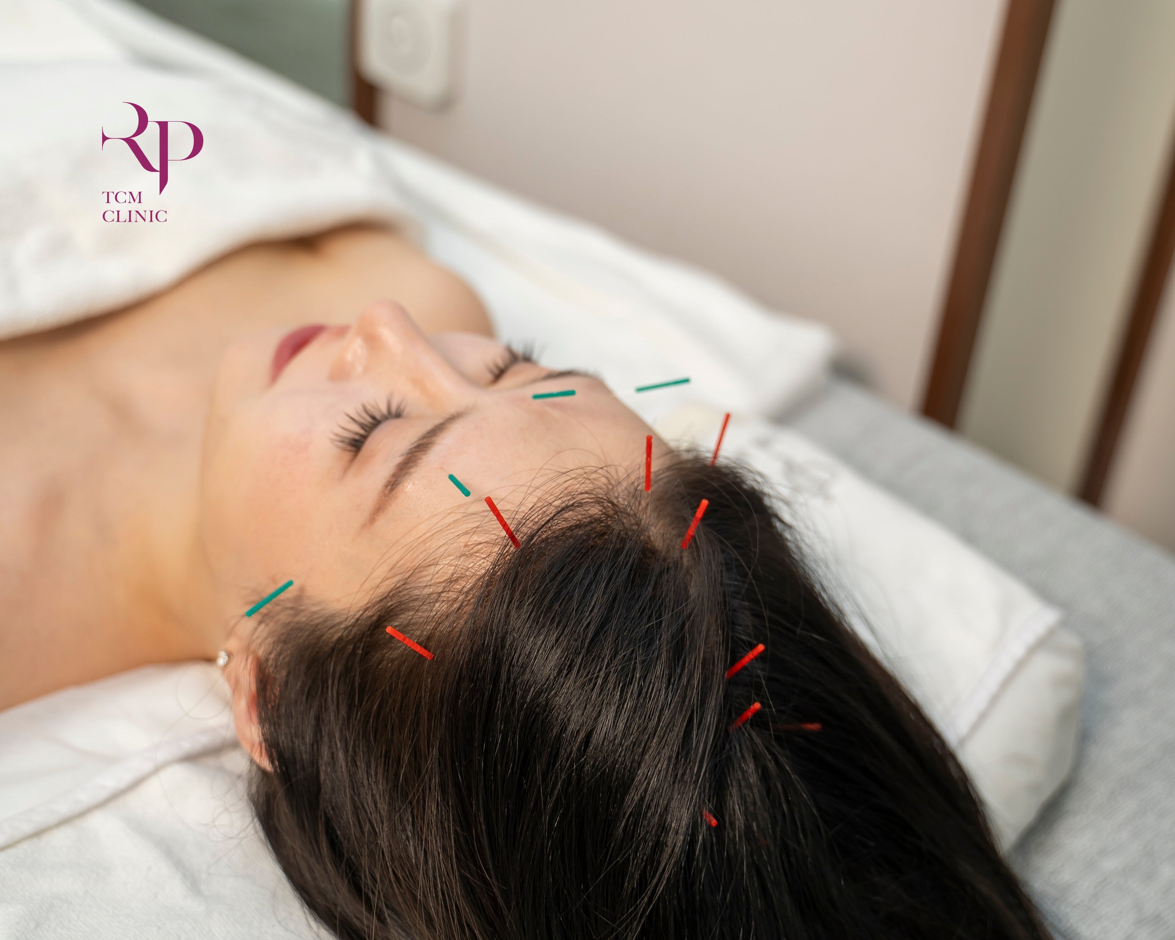 Woman receiving acupuncture with needles on her head in a clinical setting.