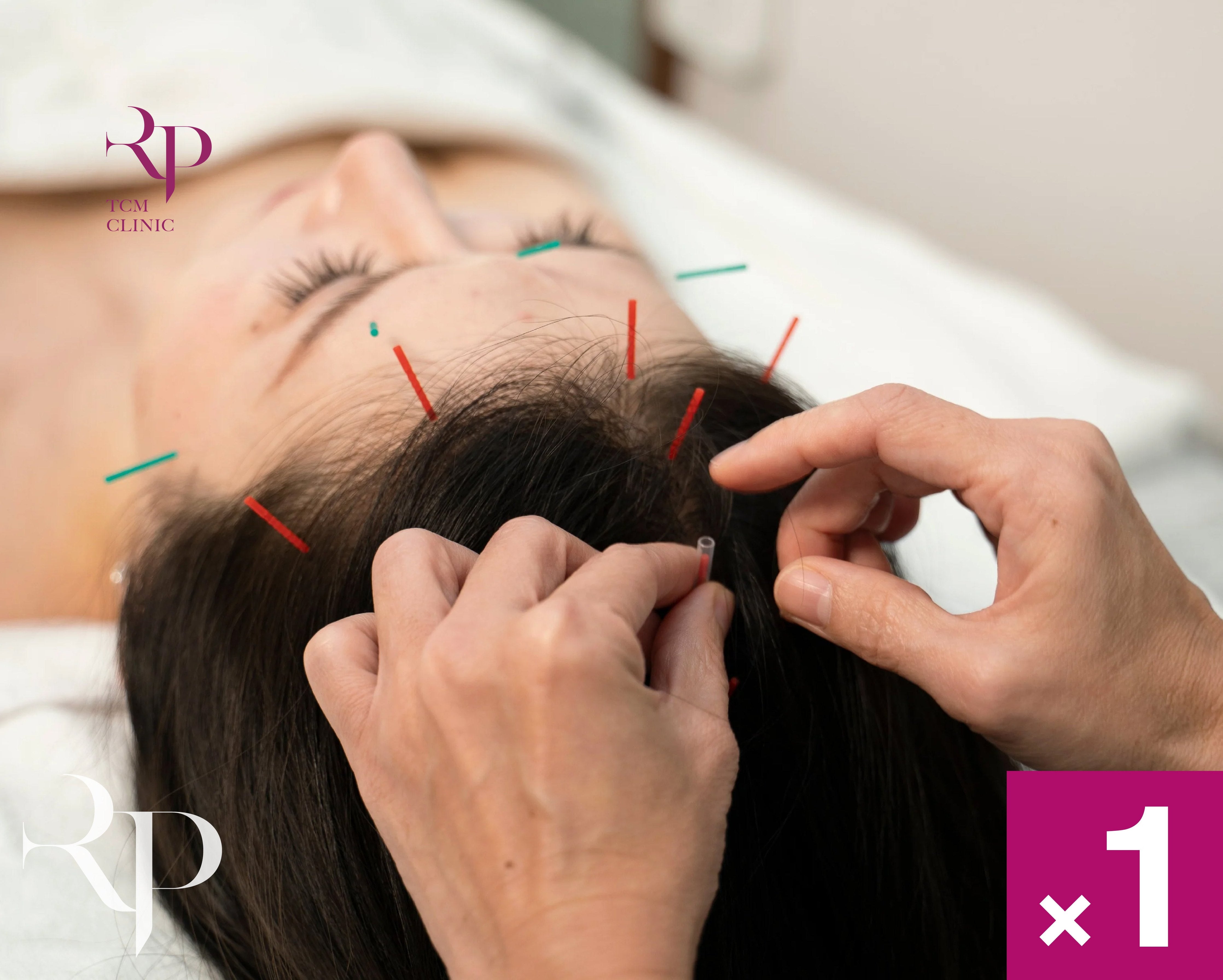 Person receiving acupuncture on the head with visible brand logo.