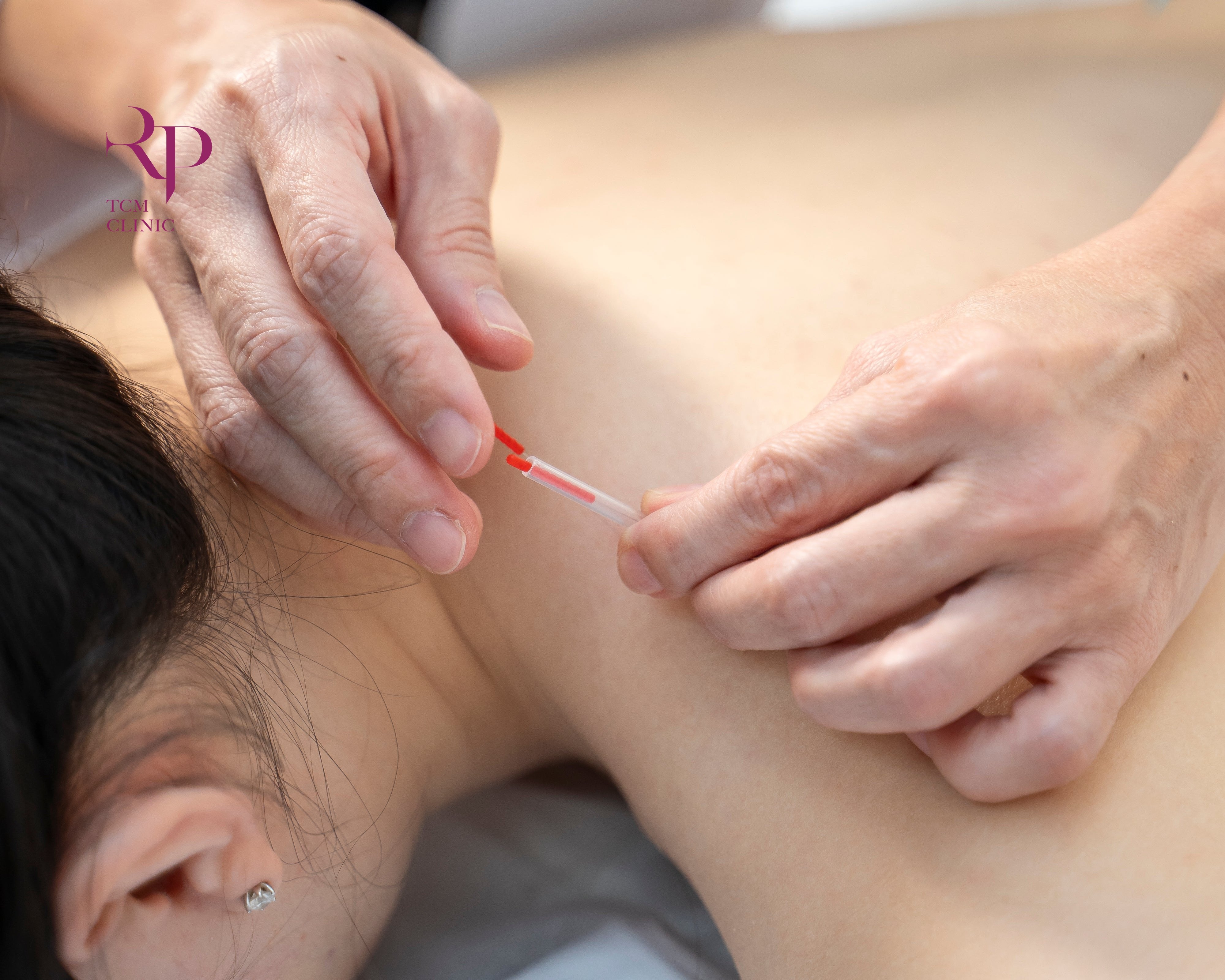 Person receiving acupuncture with needles on a person's back.