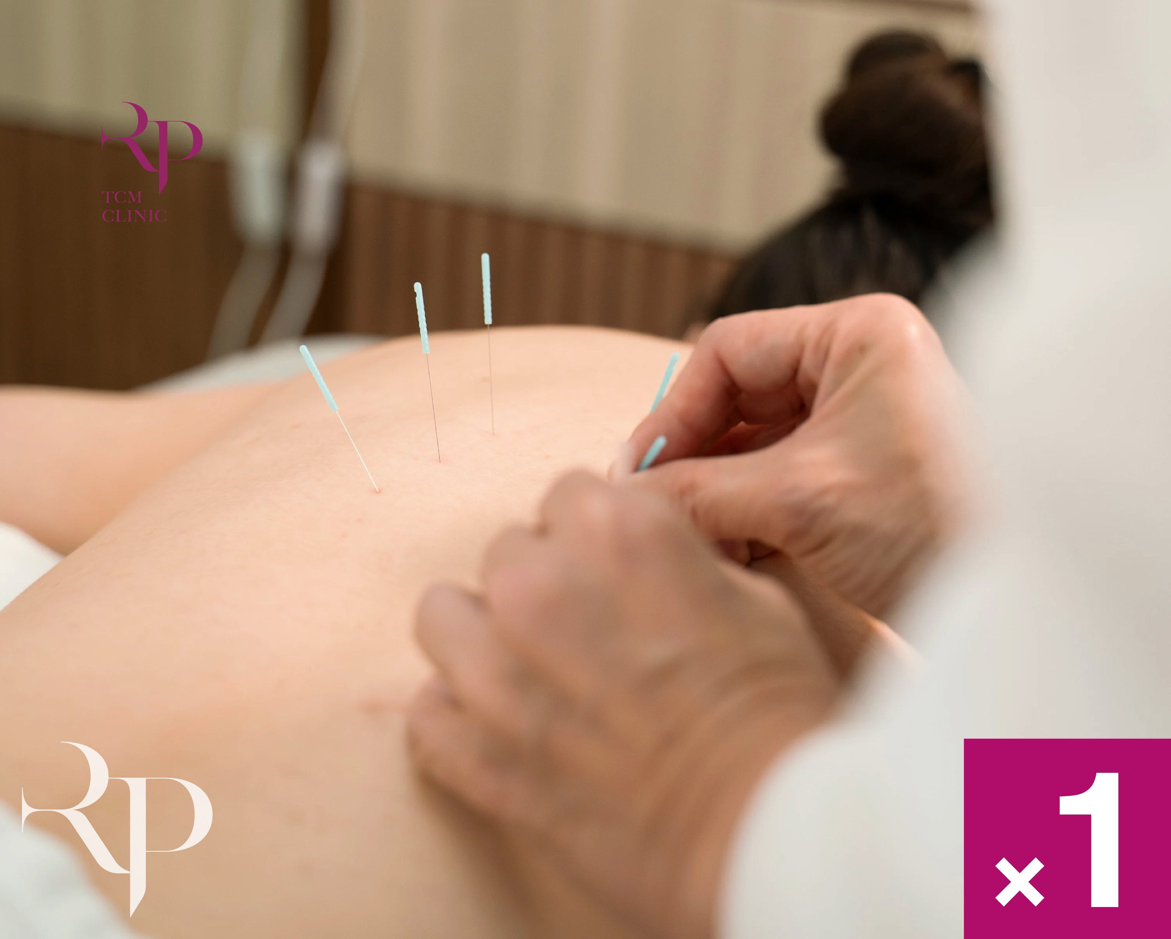 Acupuncture procedure being performed on a person's arm with visible branding.