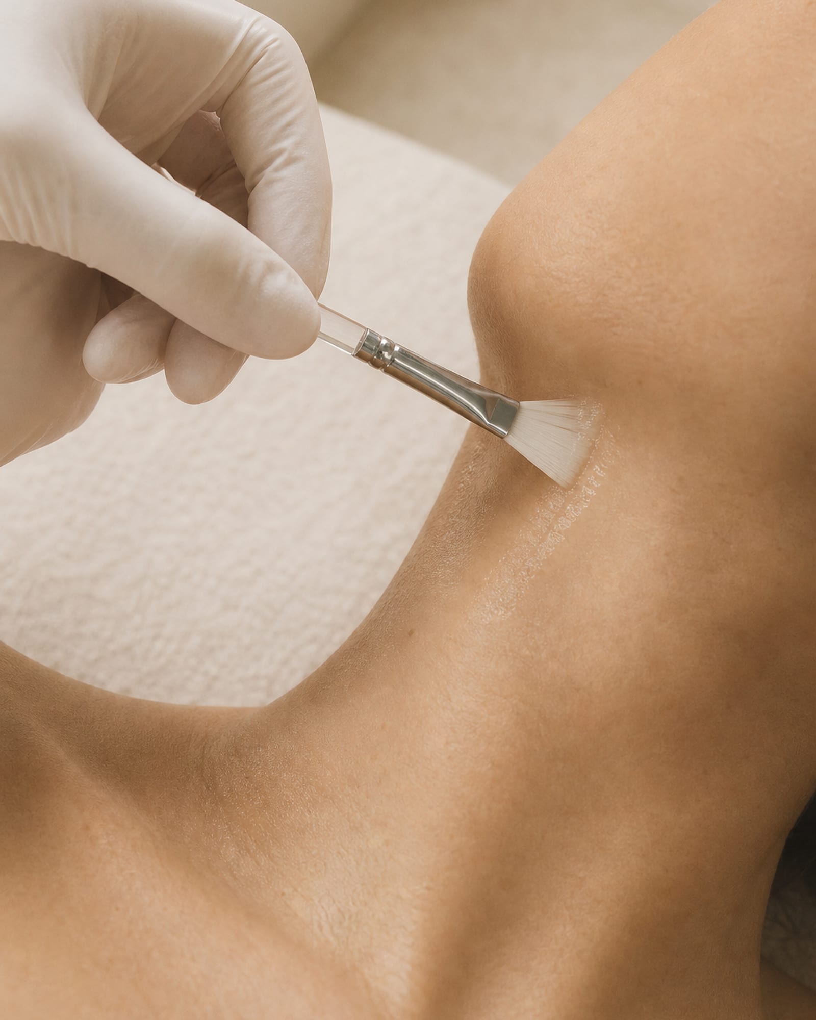 Chemical Peel — image 2
