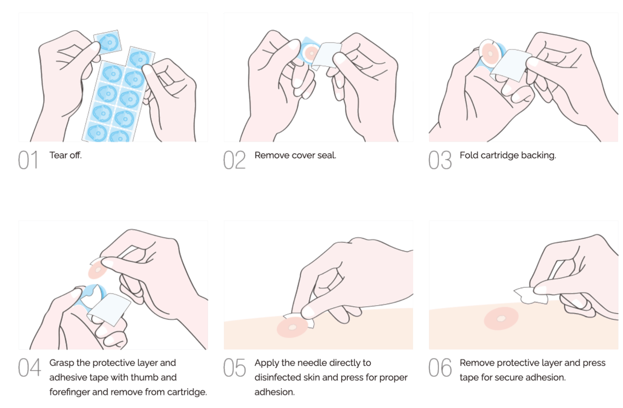 Four steps for applying a Pyonex press needle: clean the skin, peel the backing, place the patch, press gently.